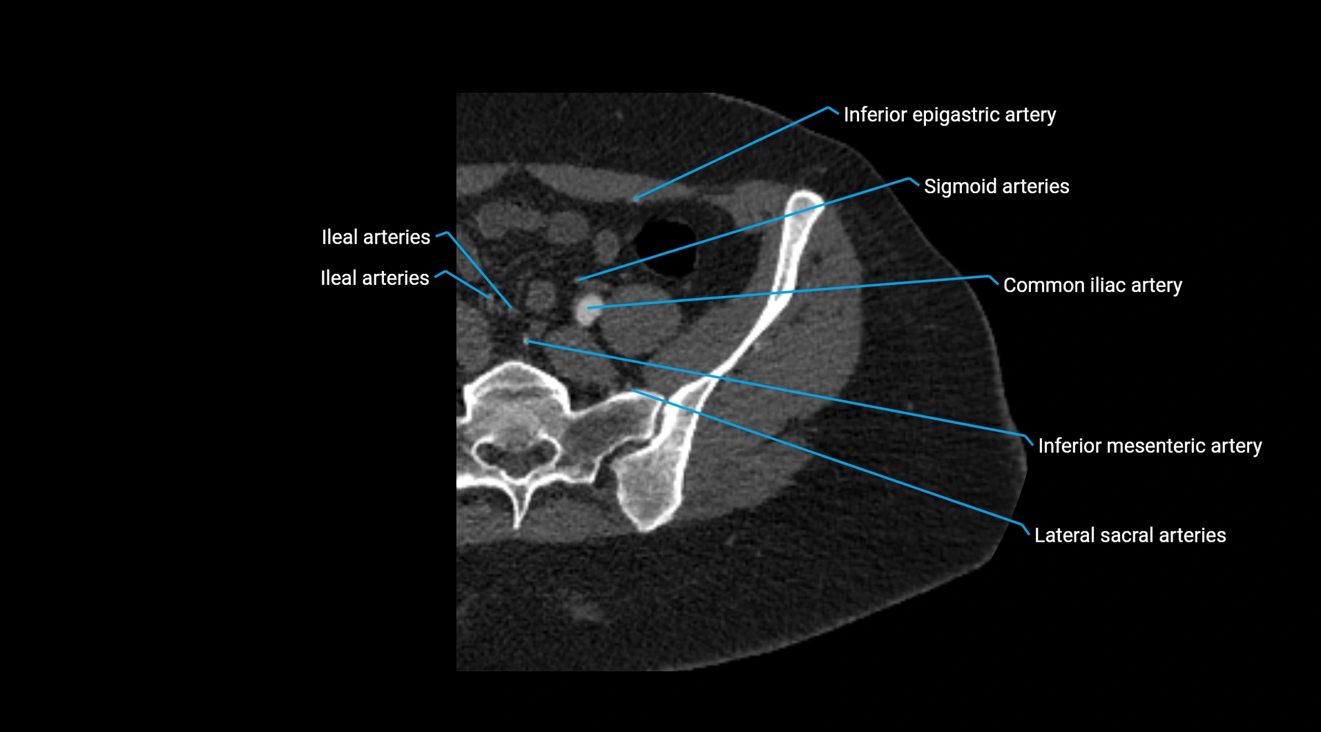 CTA lower limb cross sectional anatomy labelled image _20.webp